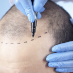 Hair Replacement Innovation